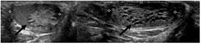 Cystic Dysplasia of the Rete Testis: Case Report and Systematic Review of the Literature